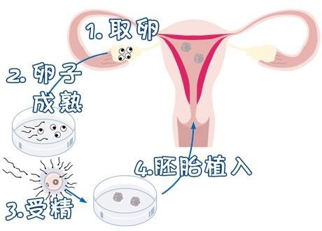 供卵代孕要多少费用